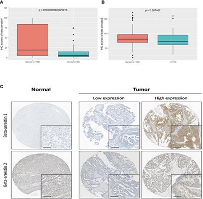 Prognostic value of β-Arrestins in combination with glucocorticoid receptor in epithelial ovarian cancer